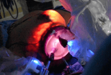 Robotic Breast Surgery